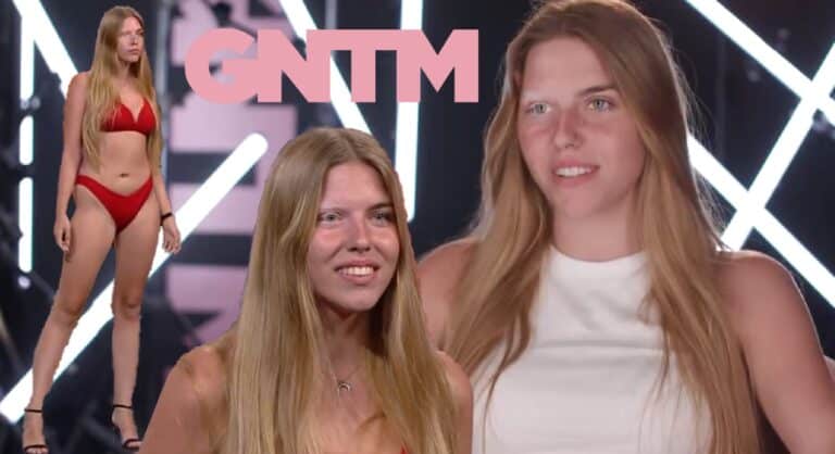 GNTM 5: Η 18χρονη Τζούλια από την Ουκρανία με την λεύκη που “τρέλανε” τους κριτές – “Ξύπνησα και το μισό μου πρόσωπο ήταν λευκό” (video)